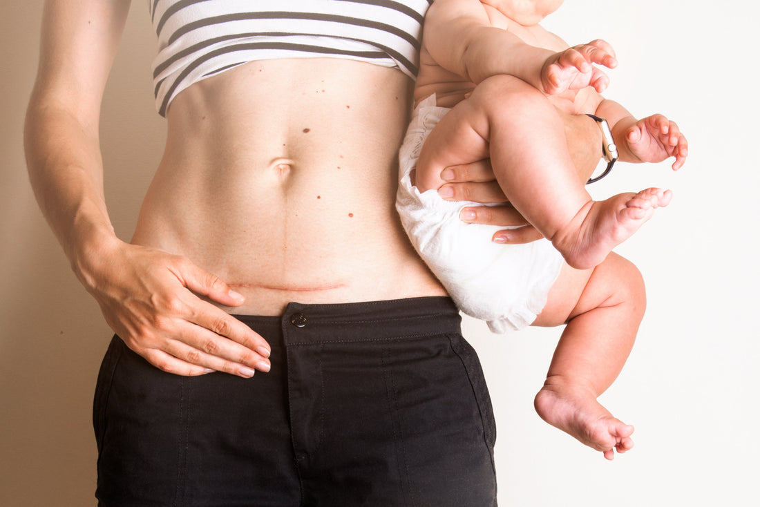 Tips for Healing After Cesarean Birth